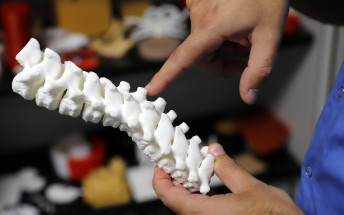 Son Espases utilitza la impressió 3D per planificar intervencions quirúrgiques