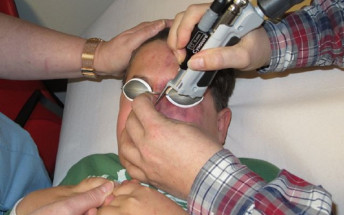 El Servei de Dermatologia adquireix el làser de colorant per eliminar les taques vermelles de la cara que servirà per evitar el desplaçament dels pacients a la península