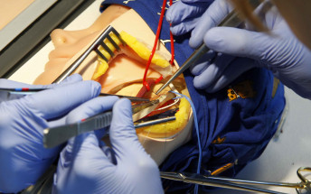 Son Espases realiza un centenar de intervenciones en el año para prevenir el ictus