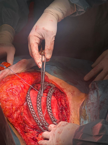 Esta imagen ilustra que: Son Espases se suma a la cirugía a medida con una reconstrucción pionera con costillas de titanio impresas  en 3D