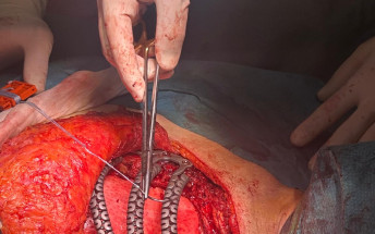 Son Espases se suma a la cirugía a medida con una reconstrucción pionera con costillas de titanio impresas  en 3D