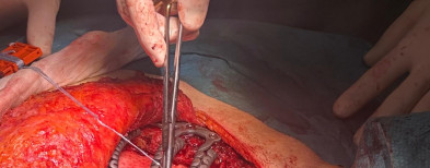 Son Espases se suma a la cirugía a medida con una reconstrucción pionera con costillas de titanio impresas  en 3D